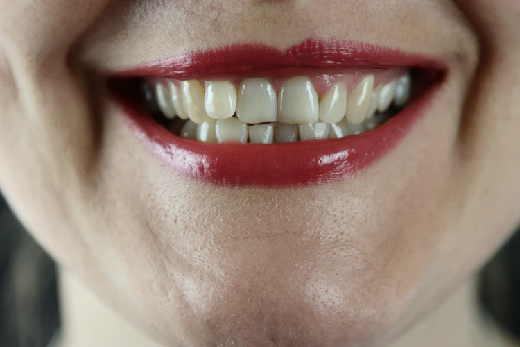 قد ينتج عن مشاكل الأسنان ترهل بالوجه أو الفكين على الأخص