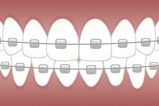 ما هو تقويم الأسنان